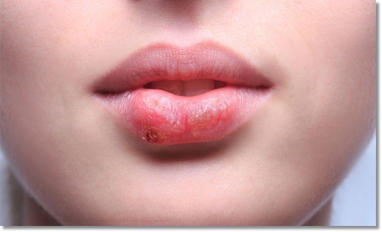 herpes-labial-1.jpg